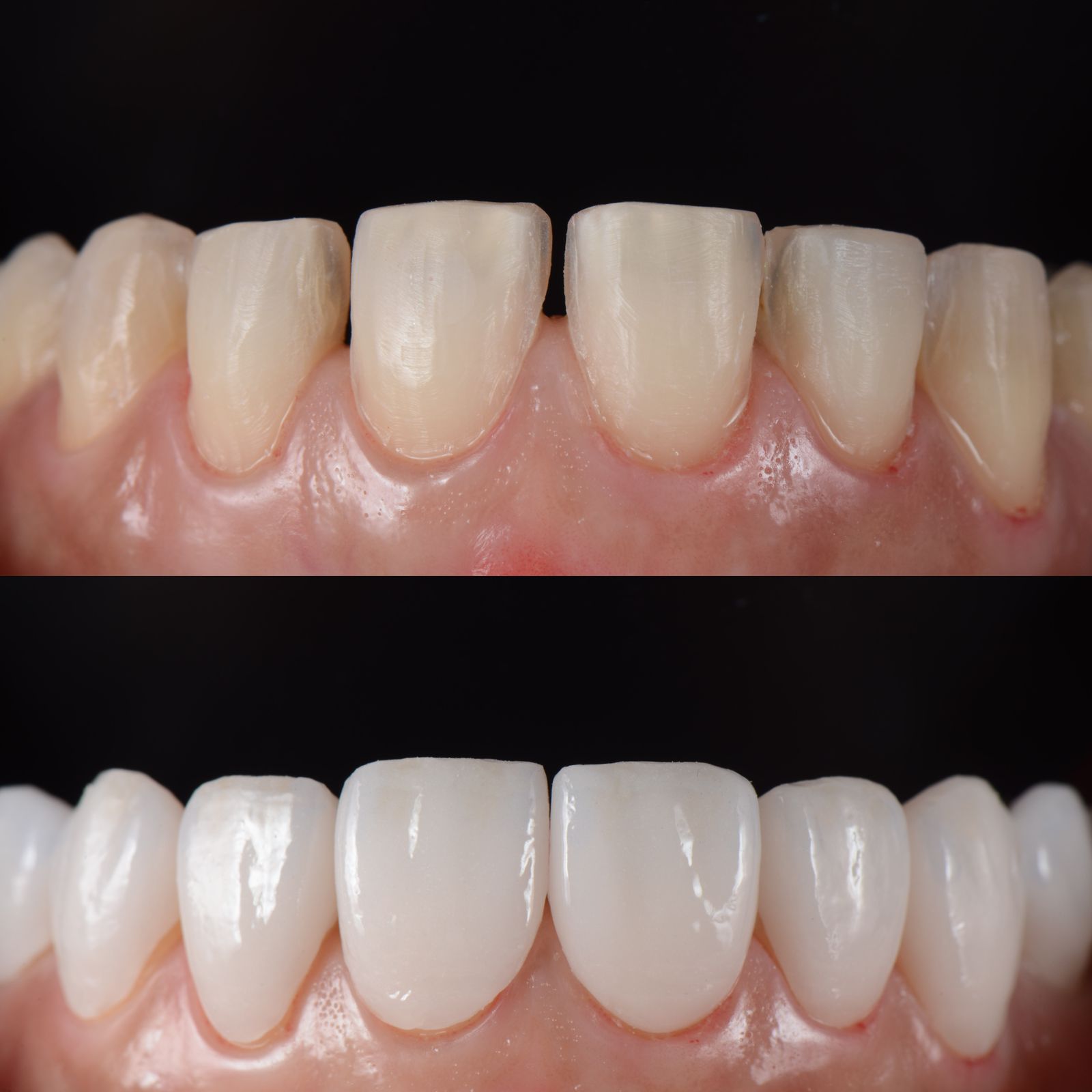 The original before and after dental photograph. Before above, after below.